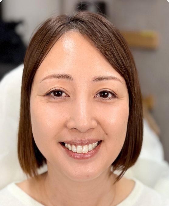 左右差がある眉 → お顔全体が自然なバランスに（施術後）