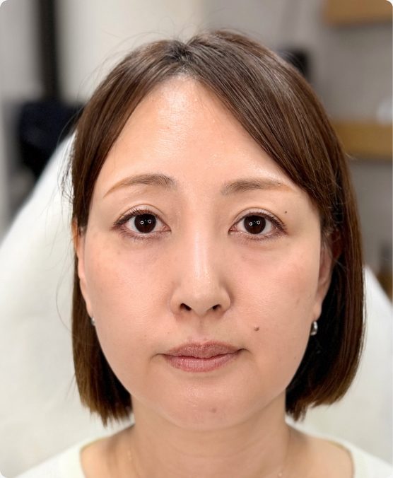 左右差がある眉 → お顔全体が自然なバランスに（施術前）