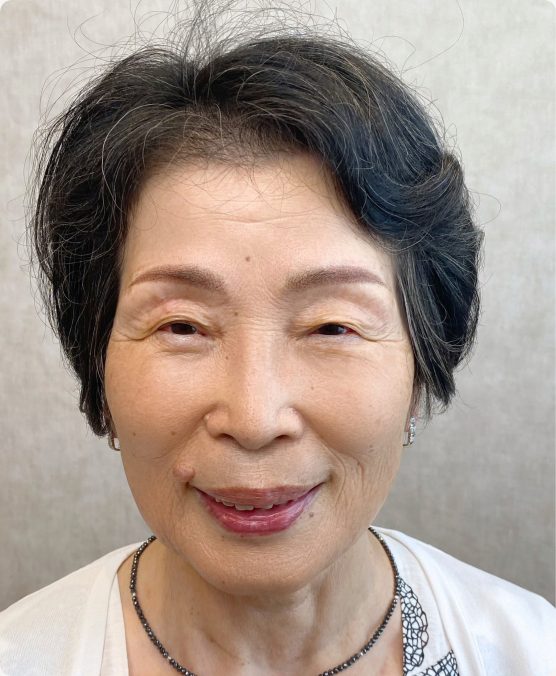 マロ眉 → 骨格に合った眉尻でお顔全体が引き締まる（施術後）