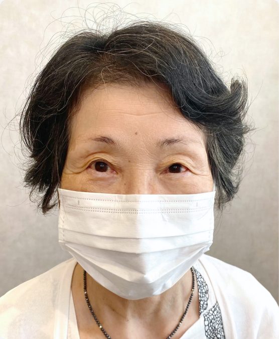 マロ眉 → 骨格に合った眉尻でお顔全体が引き締まる（施術前）