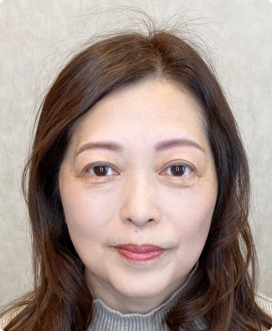 上がり眉 → お顔のバランスに合ったセミアーチ眉に（施術後）
