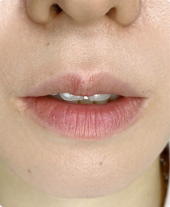 色がないリップ → ナチュラルな血色感で仕上げ（施術前）